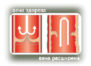 Схема кровотока при здоровых и расширенных венах Схема кровотока при здоровых и расширенных венах